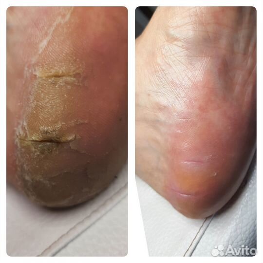 Педикюр подология