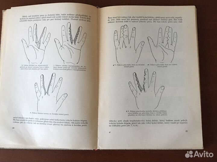 Пластическая хирургия кисти