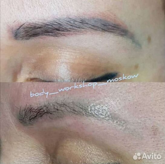 Удаление татуировок и татуажа