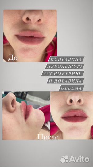 Увеличение губ