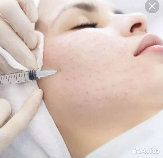 Увеличение губ