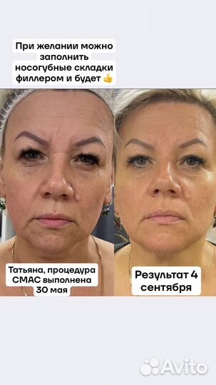 Минус 10 лет за одну процедуру СМАС лифтинг