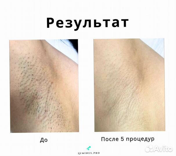 Диодный лазер для эпиляции Lumines Макс’Ван 1200W