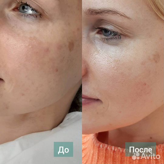 Джесснера пилинг