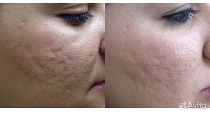 Безоперационная блефаропластика