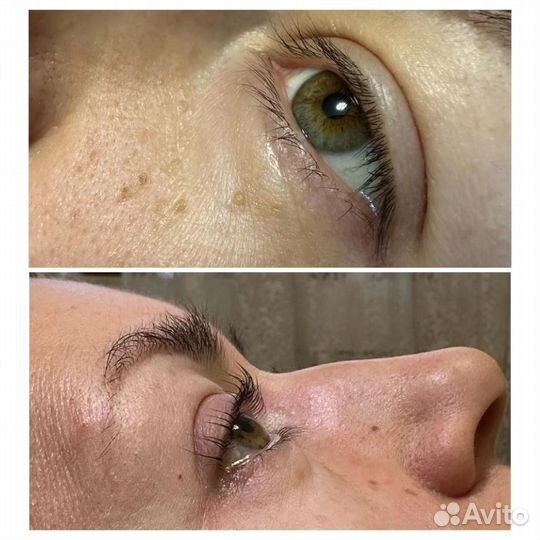 Липолитики тела, лицо