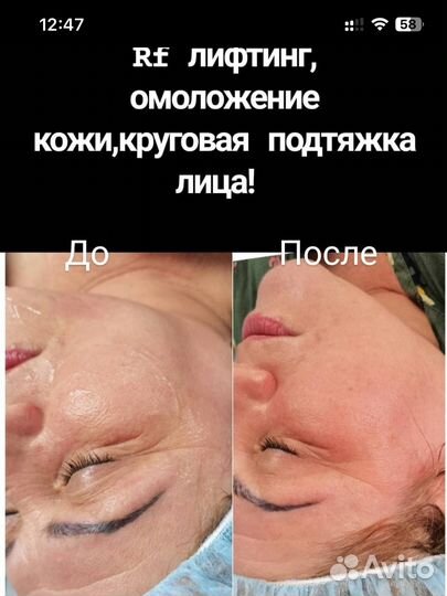 Лазерная эпиляция,фотоомоложение,rf лифтинг