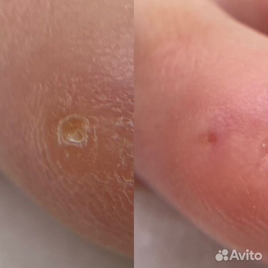 Подолог. Вросший ноготь. Титановая нить