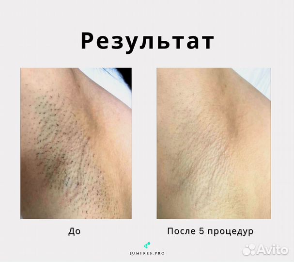 Аппарат для эпиляции Lumines MaxOne 1200вт