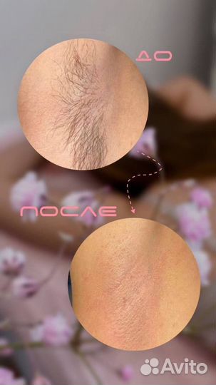 Депиляция воском: подмышки