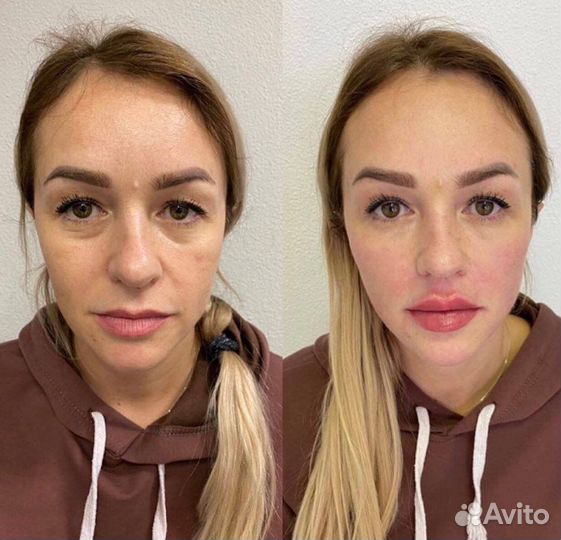 Косметолог, губы, мезо