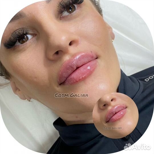 Увеличение губ, ботокс