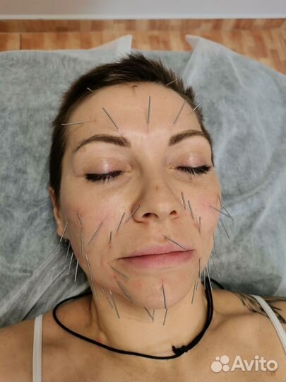 Иглотерапия, кетгут терапия, точки голода