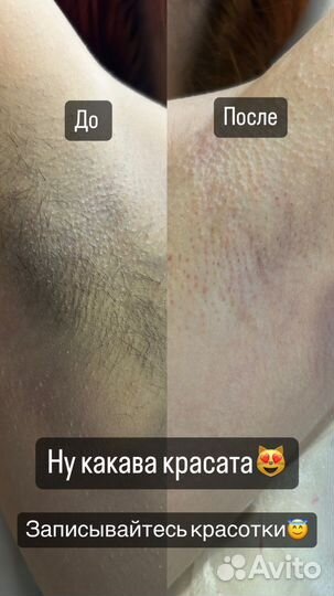 Восковая депиляция