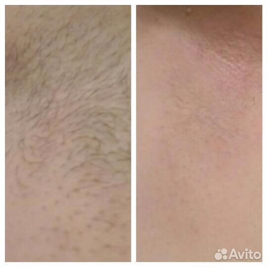 Эпиляция (полимерный воск, шугаринг)