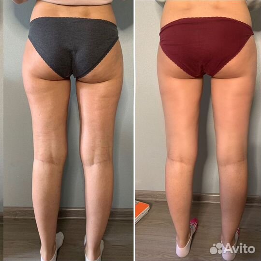 Массаж, массаж лица, RF, кавитация, лазерный липол