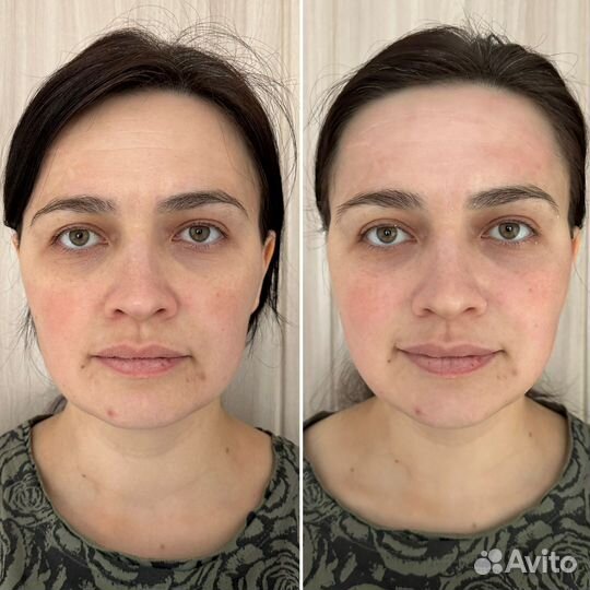 Бмс лица (подтяжка лица, объемные скулы, губы)