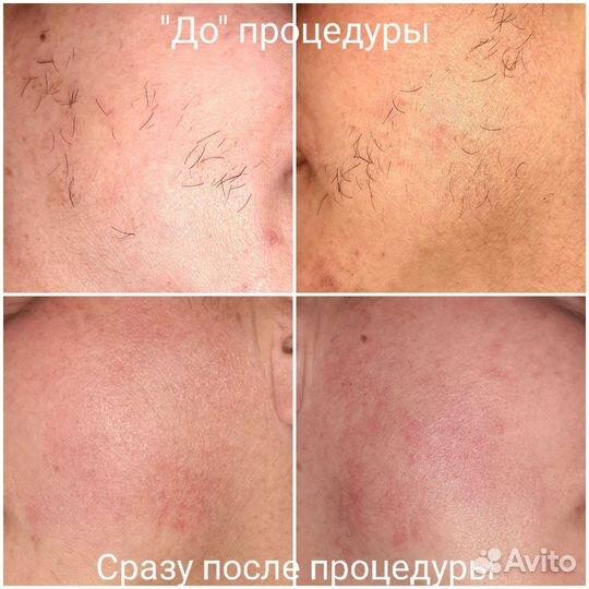 Электроэпиляция