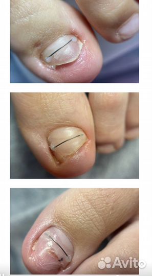 Педикюр женский,мужской, «Сложная стопа»