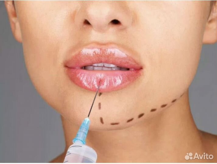 Увеличение губ