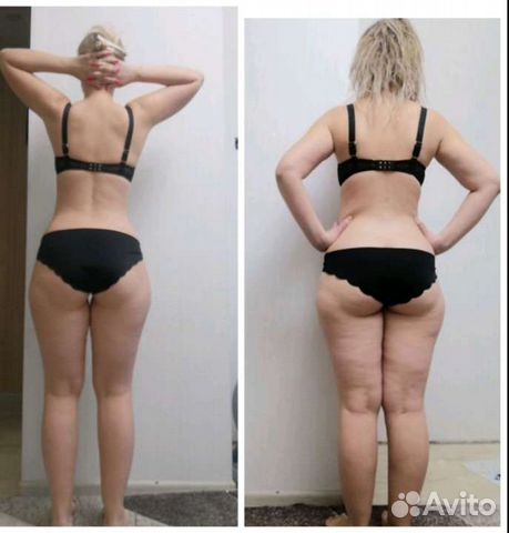 Криолиполиз