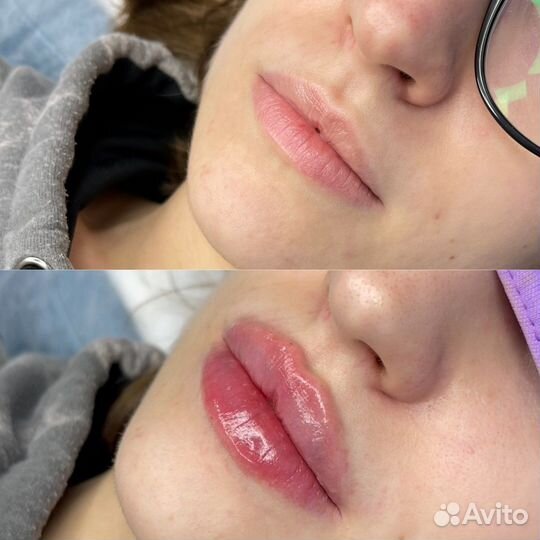 Увеличение губ