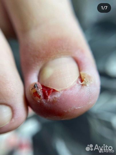 Педикюр медицинский подолог