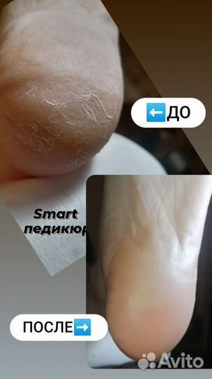 Педикюр на дому