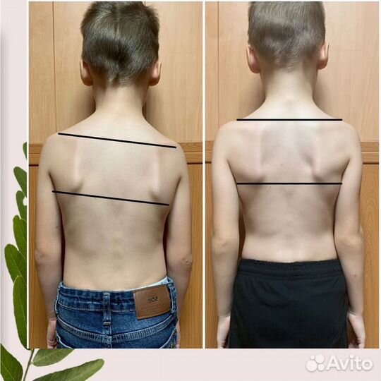 Массаж при сколиозе. Мануал и остеопатия