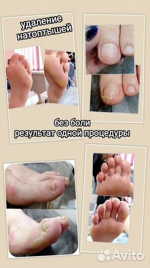 Подолог. Медицинский педикюр