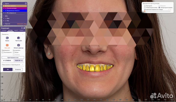 Моделировка в Exocad