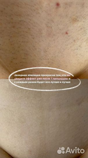 Лазерная эпиляция диодный лазер все тело 3000