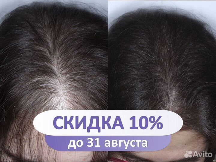 Лечение волос / пилинг / трихолог