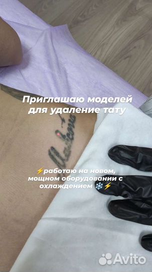 Удаление тату/ажа лазером