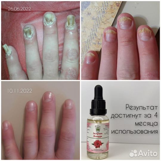 Парамедицинский педикюр пожилым с выездом на дом