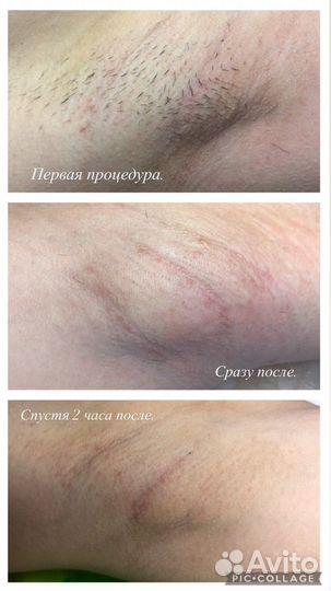 Электроэпиляция Иркутск