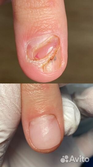 Модель с вросшими ногтями и мозолями