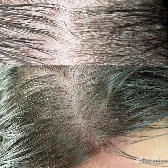 Трихопигментация головы по методу SMP