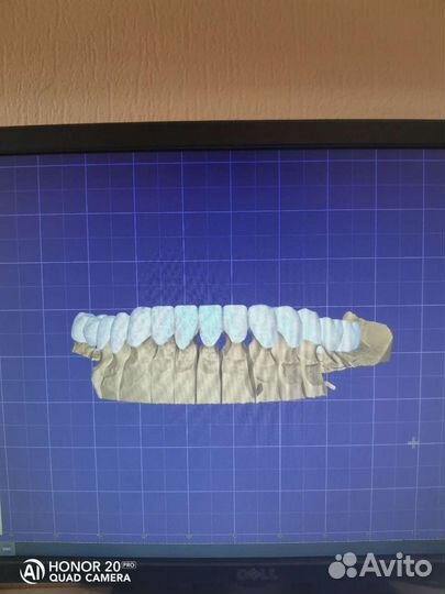 Зубной Техник, Съёмные протезы, Виниры, Керамика