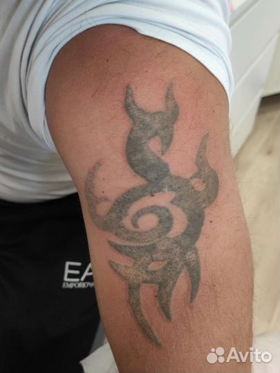 Удаление тату/перманента/татуировок/татуажа бровей