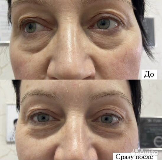 Смас лифтинг