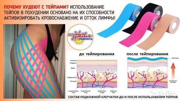 Тейпирование