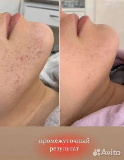Косметолог врач чистка лица и уход