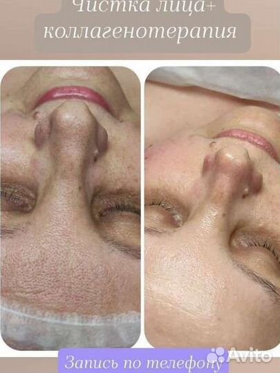 Увеличение губ