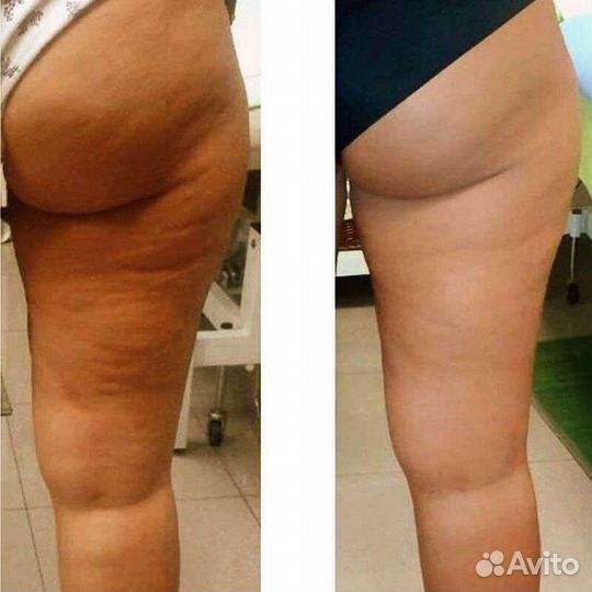 Вакуумный массаж/ Кавитация/ Биофотон/ Вибромассаж