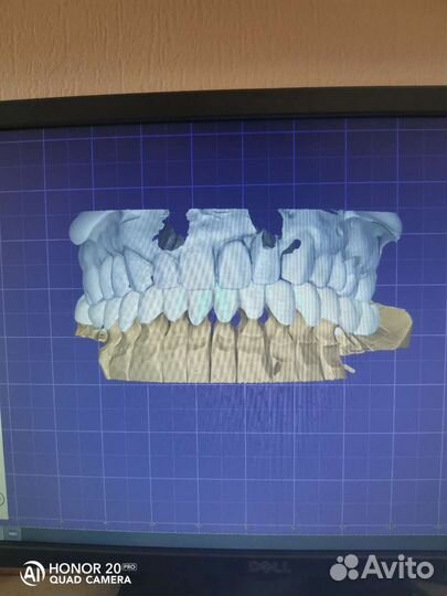 Зубной Техник, Съёмные протезы, Виниры, Керамика