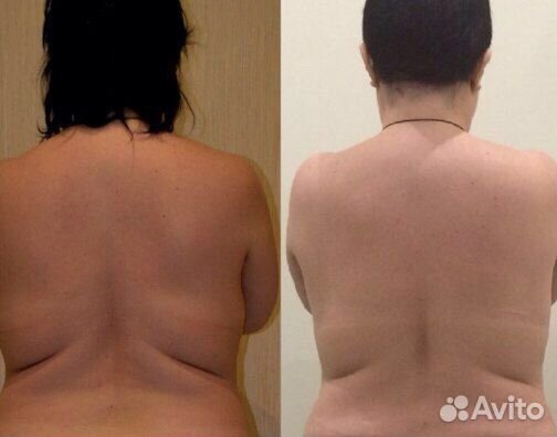 Плоский живот, бразильская попа, EMS sculpt c RF