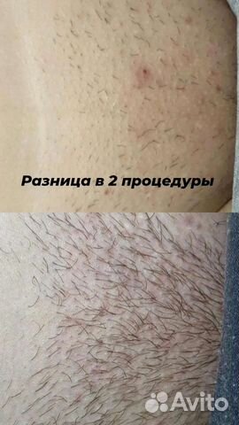 Электроэпиляция: классическое бикини