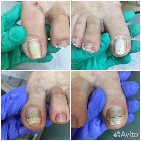 Подолог. Педикюр. Сложные стопы
