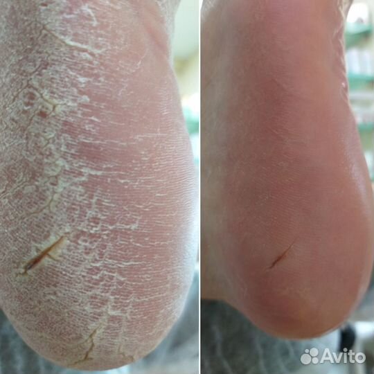 Педикюр аппаратный (Мужской и Женский) Подолог